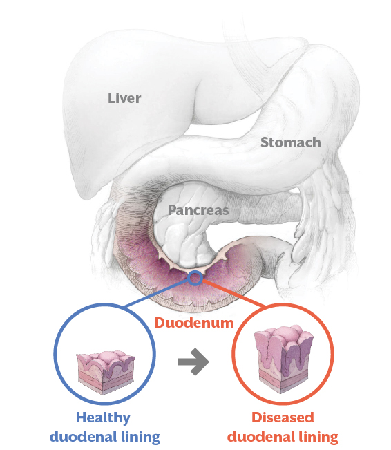 Healthy duodenal lining VS. Diseased duodenal lining