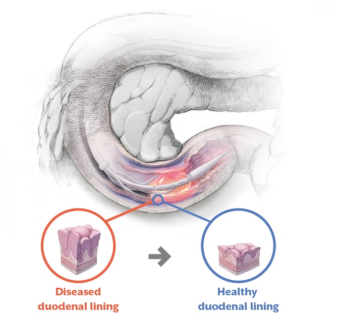 Healthy duodenal lining VS. Diseased duodenal lining